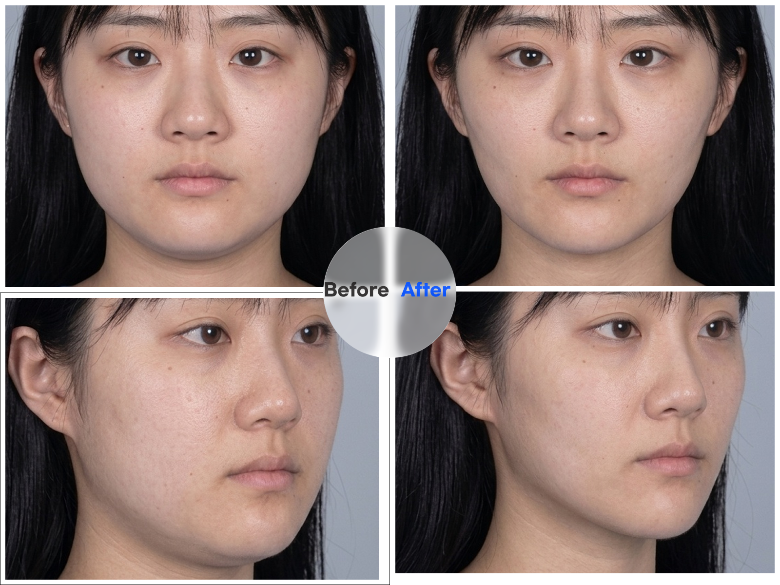 Before DCA double chin injection — submental fat before treatment