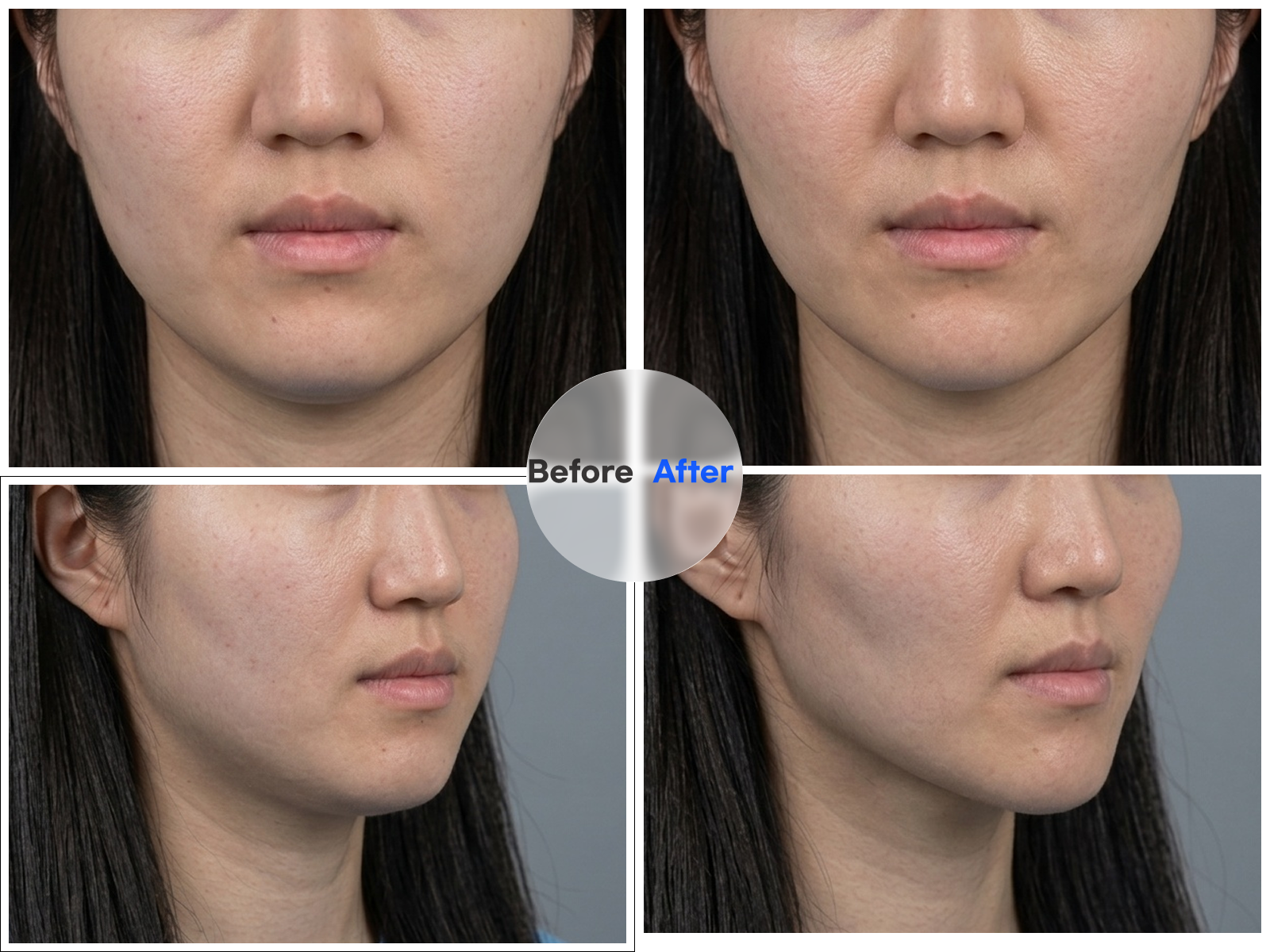 After DCA double chin injection — improved jawline and reduced submental fat