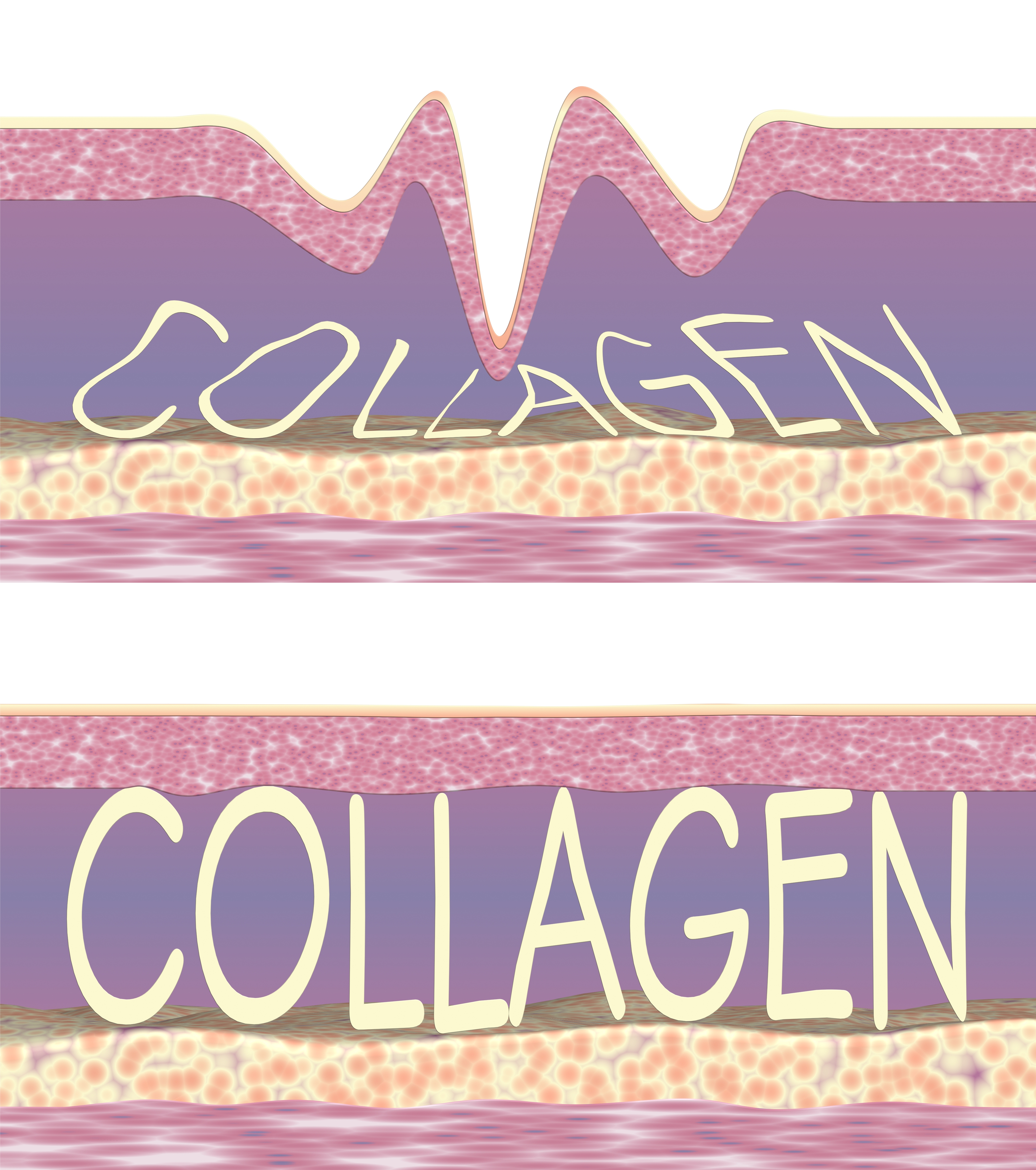 Step 3 — collagen synthesis after DCA fat cell removal under the chin