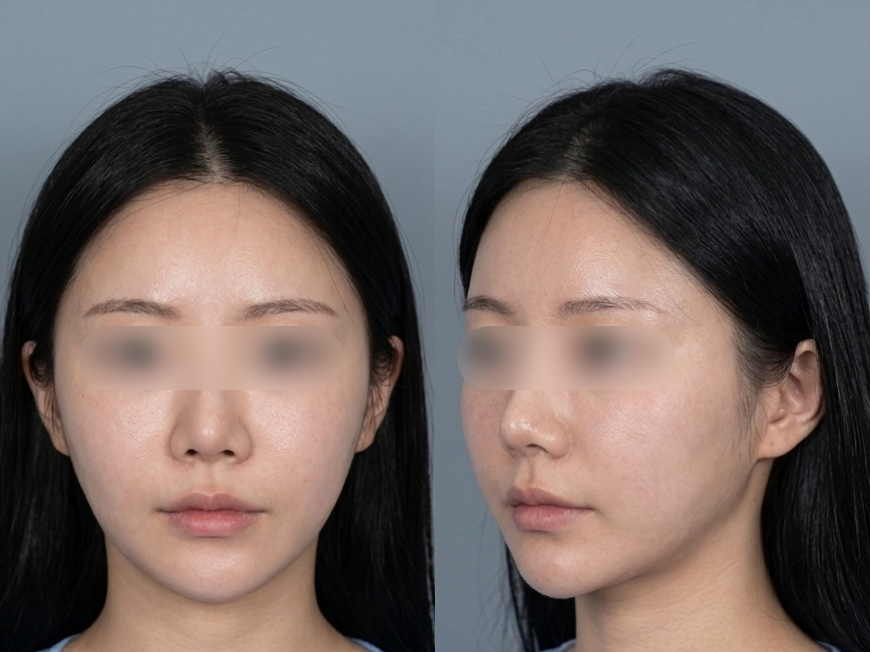 ตัวอย่างภาพหลังทำ - เส้นกรอบหน้าที่ไขมันใต้คางลดลง (ภาพสร้างด้วย AI อ้างอิงจากเคสจริง)