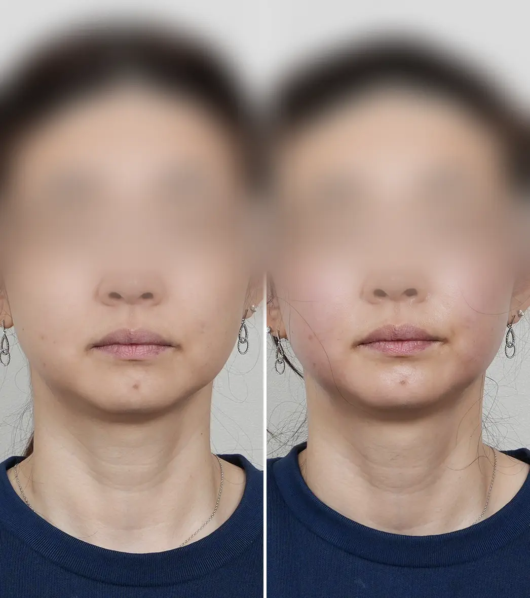 Alltite before and after front view — facial contour lifting