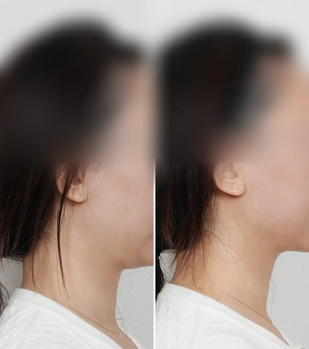 Alltite before and after side view — slimmer facial line